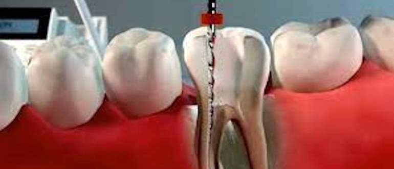 endodontia